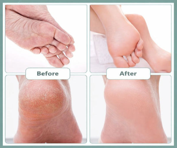 Beautiful feet of a women who is using electric callus remover for removing dead skin