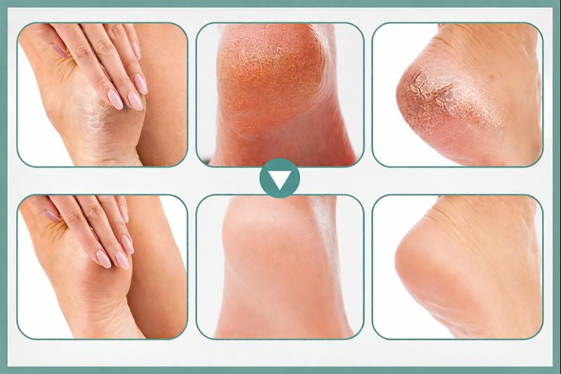 Before and after feet of confident women after using callus remover